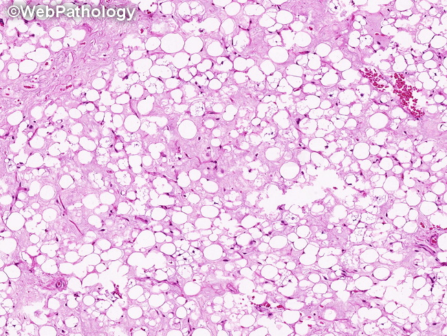 Soft Tissue_Lipomatous_Lipoblastoma17_resized.jpg